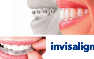 Who Invisalign Is Good For?