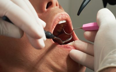 Mountain And Sea Dental- What Is A Frenectomy?